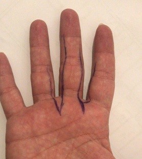 https://www.marsoclinic.com/Fa/main/Cut_finger_nerve_damage_symptoms